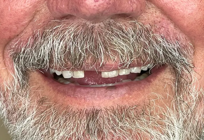 Missing front tooth before cosmetic dental restoration.